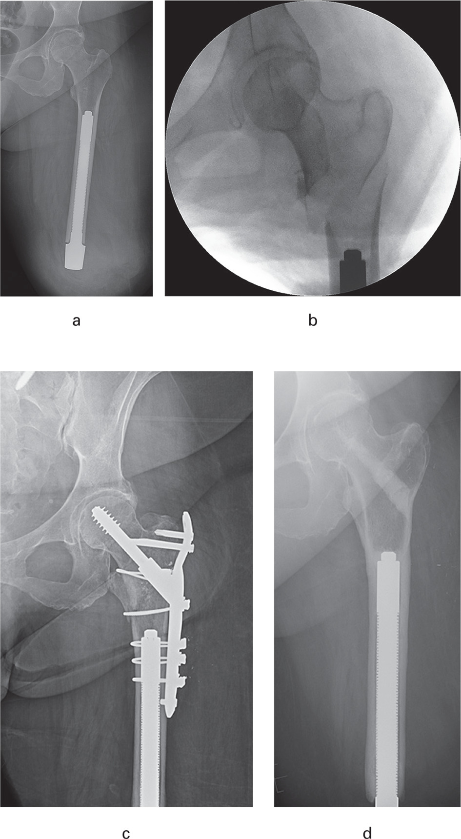 Fig. 5 
          Anteroposterior radiographs (Figures a, c, and d) and image intensification (b) of a 64-year-old woman who had a left transfemoral amputation for chronic infection after total knee arthroplasty; a) immediate postosseointegration appearance (15 years and two months after amputation); b) she sustained an intertrochanteric fracture eight months later; c) she was treated with a hybrid dynamic hip screw with features of a reconstruction plate; d) there was persistent discomfort and the hardware was removed one year later. She has not needed further care in the subsequent six years. Her K-level improved from 0 before osseointegration to 3 after fracture care, and her prosthesis wear improved from 0 hours with a socket, due to severe silicone and latex allergies, to ≥ 16 hours/day, currently.
        