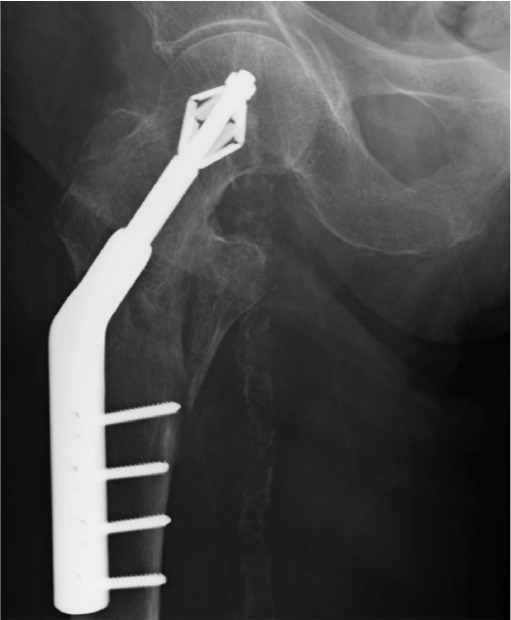 Fig. 2 
          Anteroposterior radiograph of X-Bolt Dynamic Hip Plating System fixation of a right trochanteric fracture.
        