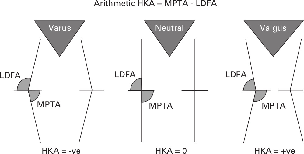 Fig. 2 
              Relationship between the lateral distal femoral angle (LDFA) and medial proximal tibial angle (MPTA) in varus, neutral, and valgus lower limb alignment with the arithmetic hip-knee-ankle angle (aHKA).
            