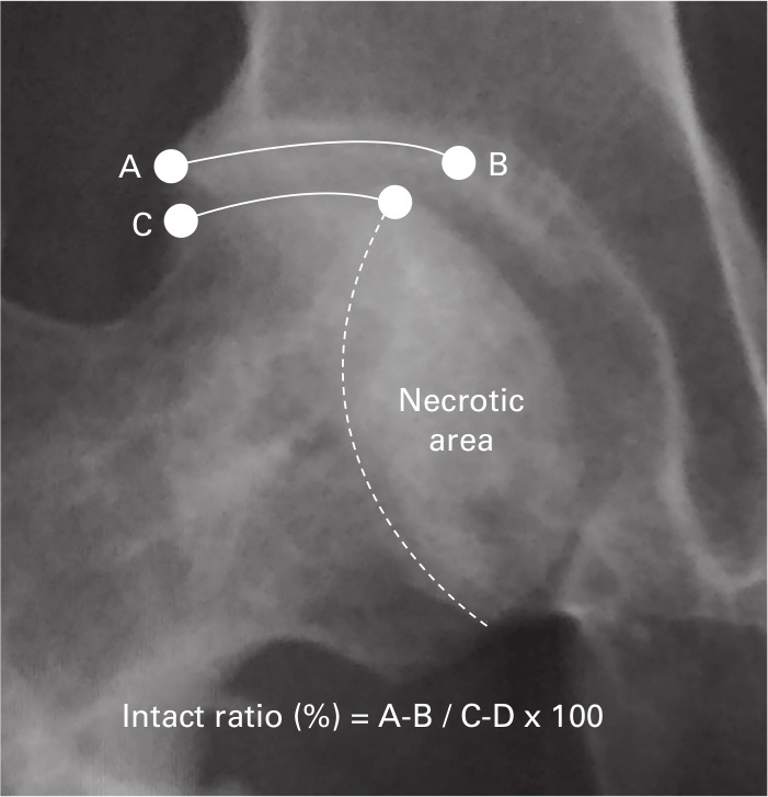 Fig. 3 
            Measurement for the ratio of the intact articular surface of the femoral head to the weight-bearing area of the acetabulum (A to B weight-bearing surface of acetabulum, and C to D intact area by osteotomy)
          