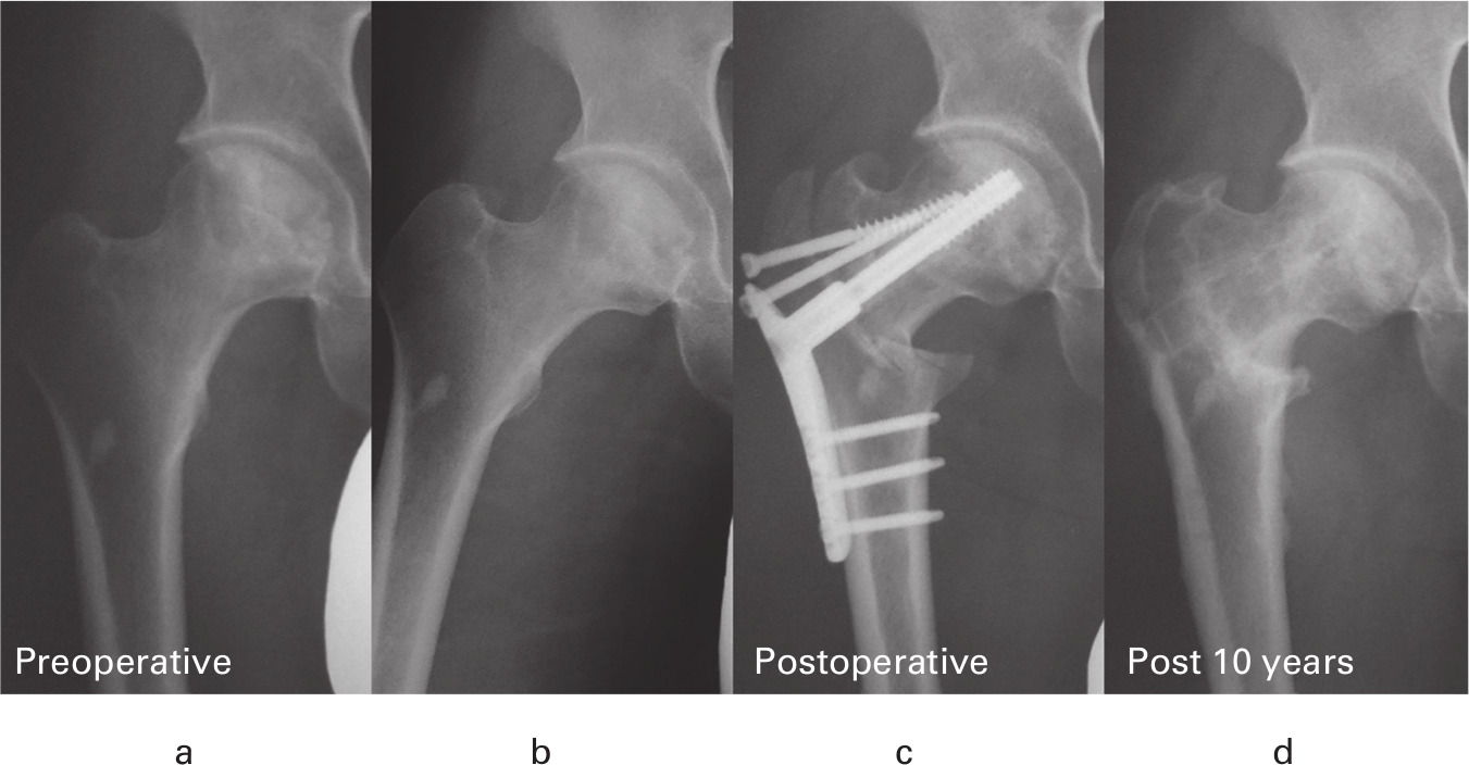 Fig. 5 
          a) Preoperative anteroposterior (AP) radiograph showing the right hip of a 33-year-old man with type C1 osteonecrosis of the femoral head. b) A preoperative AP radiograph in maximum hip abduction showing coverage of more than one-third of the weight-bearing area with an intact articular surface. c) Postoperative AP radiograph obtained one year after curved intertrochanteric varus osteotomy (CVO) showing restoration of the collapsed spheroid head. d) An AP radiograph showing a lack of osteoarthritic progression and remodelled necrotic area ten years after surgery.
        