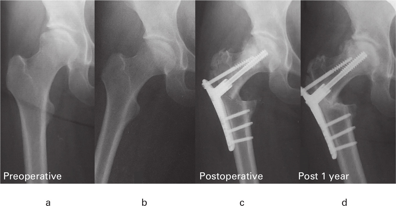Fig. 6 
          a) Preoperative anteroposterior (AP) radiograph showing the right hip of a 26-year-old woman with type C2 osteonecrosis of the femoral head. b) A preoperative AP radiograph showing a lack of coverage of more than one-third of the weight-bearing area with an intact articular surface in maximum hip abduction. c) Postoperative AP radiograph obtained two weeks after curved intertrochanteric varus osteotomy (CVO). d) The progression of collapse and osteoarthritis six months after CVO.
        