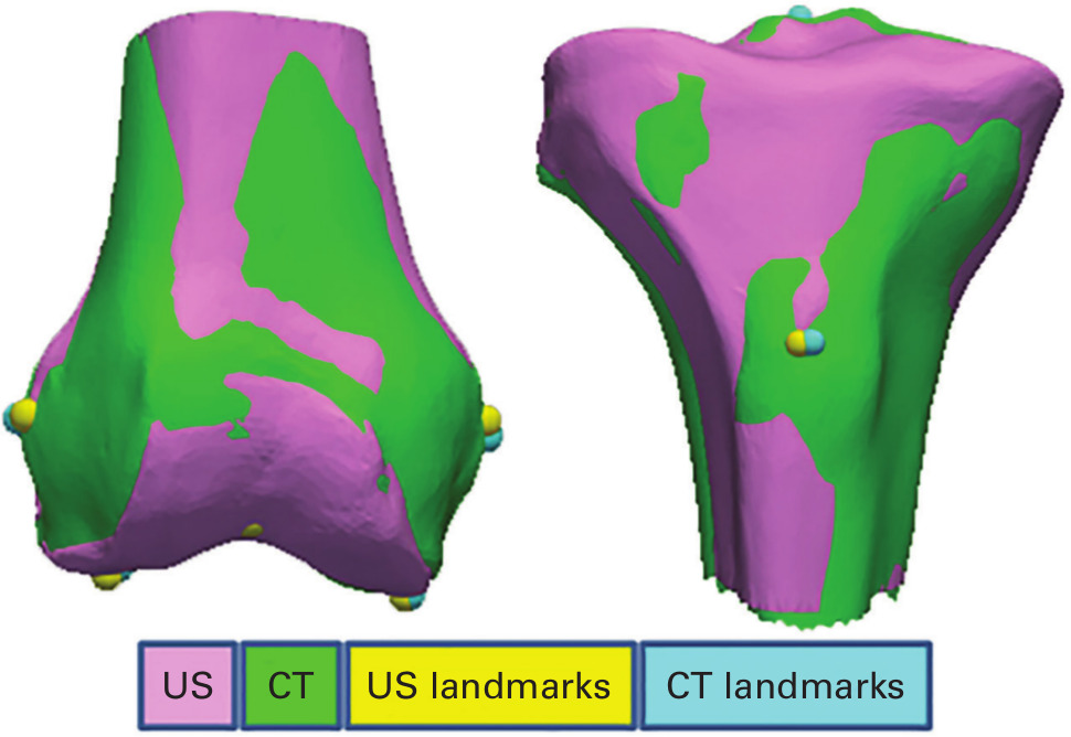 Fig. 6 
          Comparison of CT (green) and ultrasound (magenta) femoral and tibial landmarks. US, ultrasound.
        