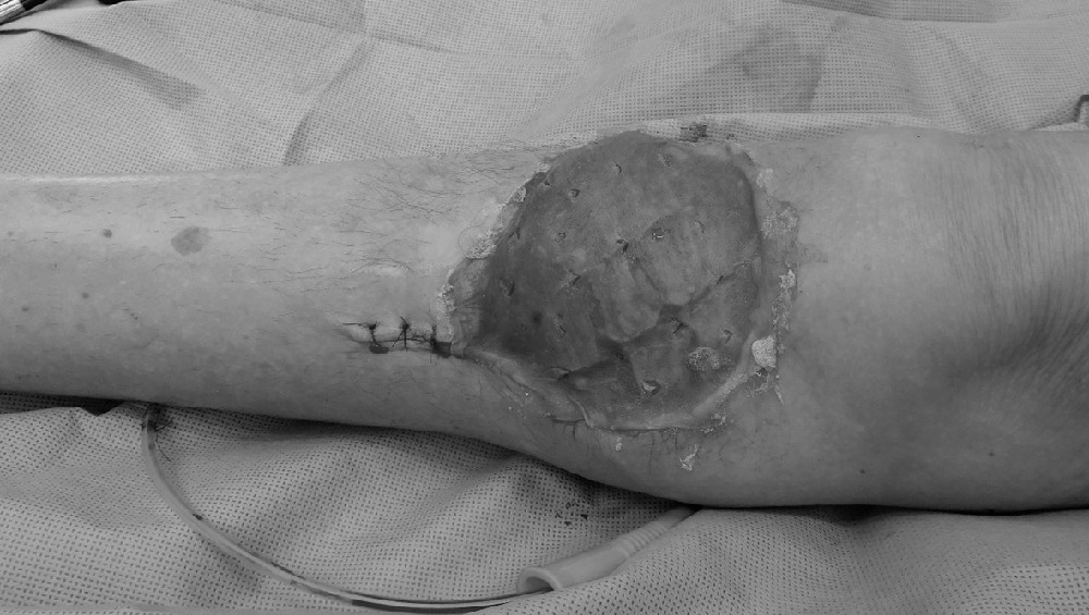Fig. 3 
          The soft-tissue defect was covered with a local gastrocnemius muscle flap and split skin graft from the thigh.
        