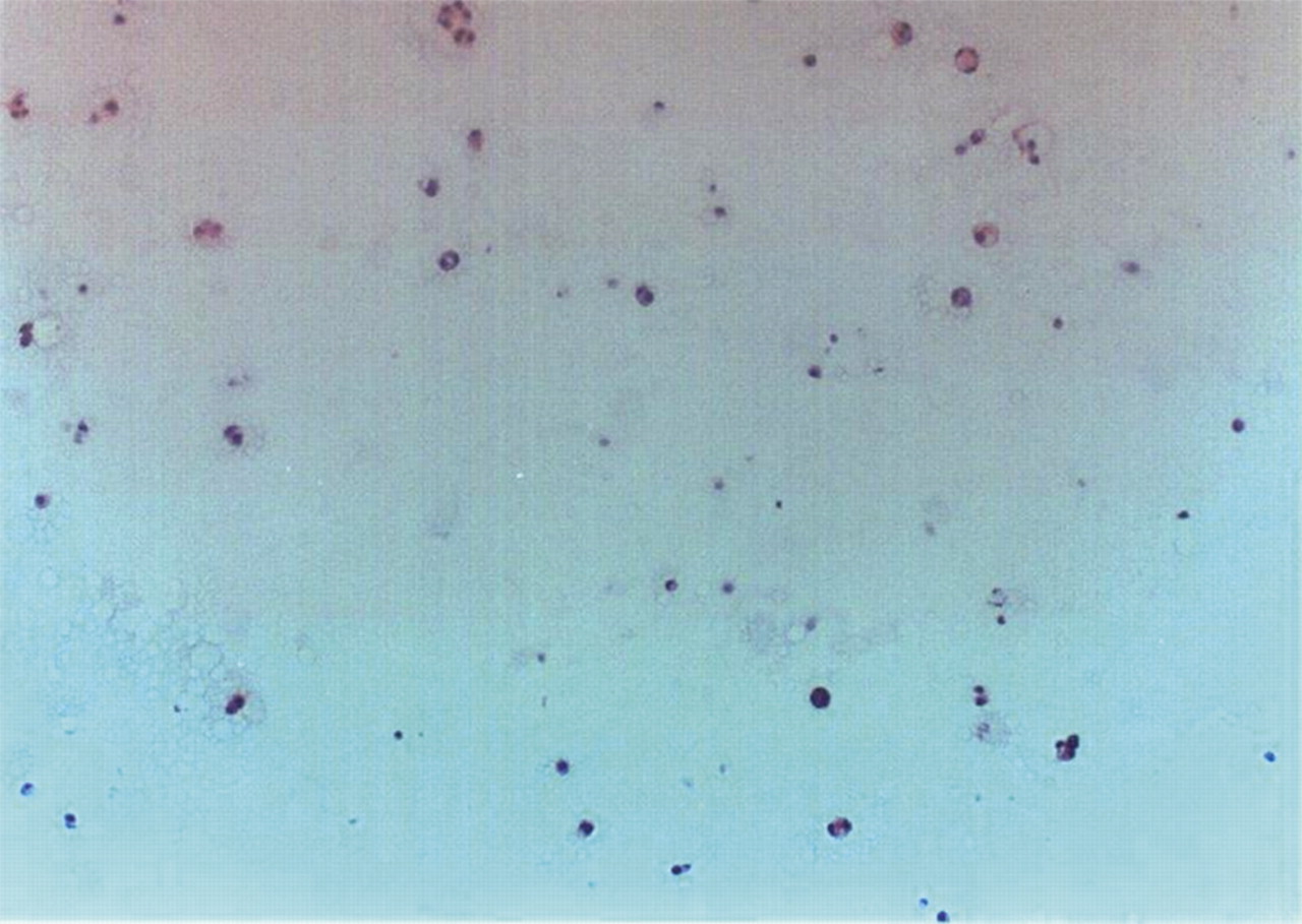 Fig. 5a, Fig. 5b, Fig. 5c, Fig. 5d  
            Photomicrographs of human chondrocytes in alginate beads at day 14 in Safranin-O stain (x 20 magnification). a) in static culture, centre of the bead; b) in rotating wall vessel (RWV) bioreactor, centre of the bead; c) in static culture, peripheral edge of the bead and d) in RWV bioreactor, peripheral edge of the bead.
          