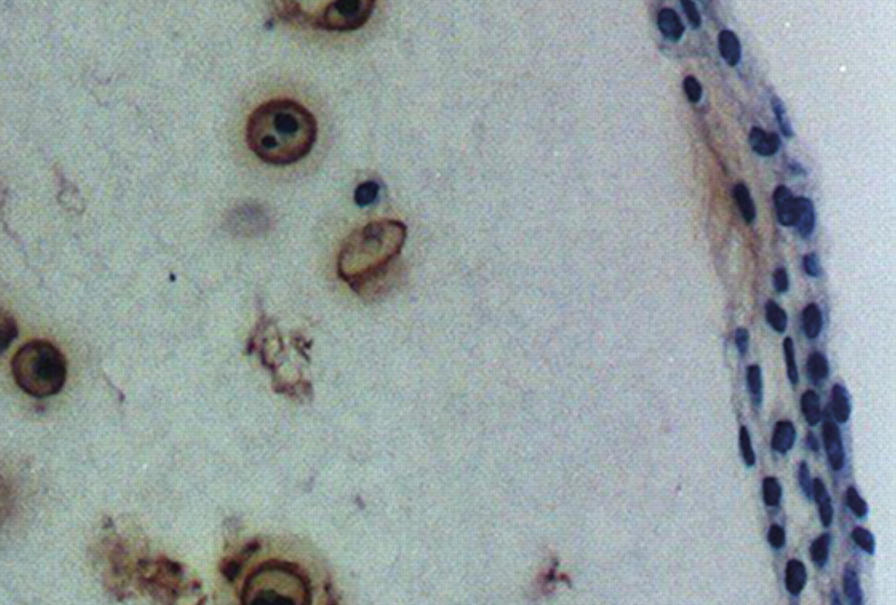 Fig. 6a, Fig. 6b, Fig. 6c, Fig. 6d  
            Photomicrographs showing collagen type-II in a) bovine static culture; b) bovine rotating wall vessel (RWV); c) human static culture and d) human RWV.
          
