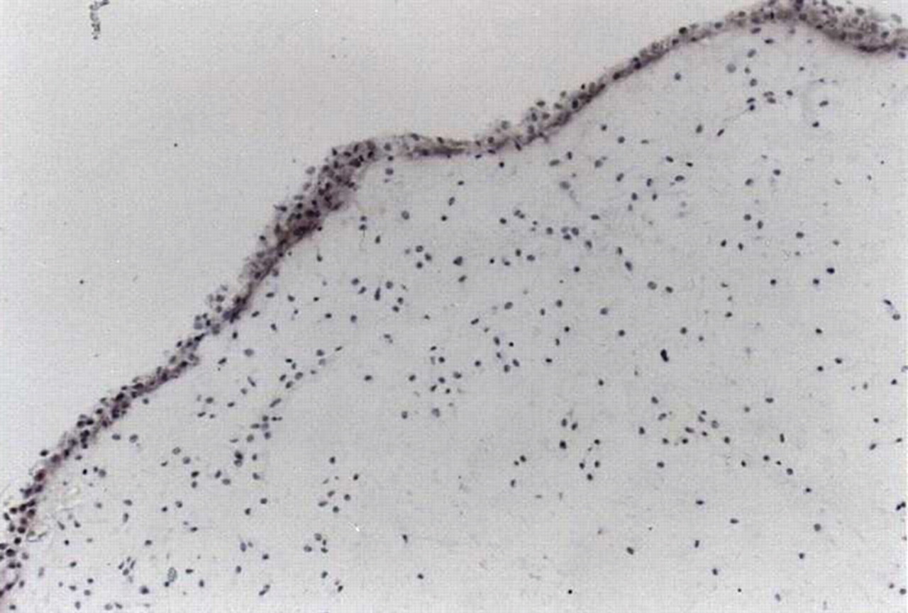 Fig. 7a, Fig. 7b  
            Photomicrographs showing collagen type-I staining in a) bovine static culture and b) human static culture.
          