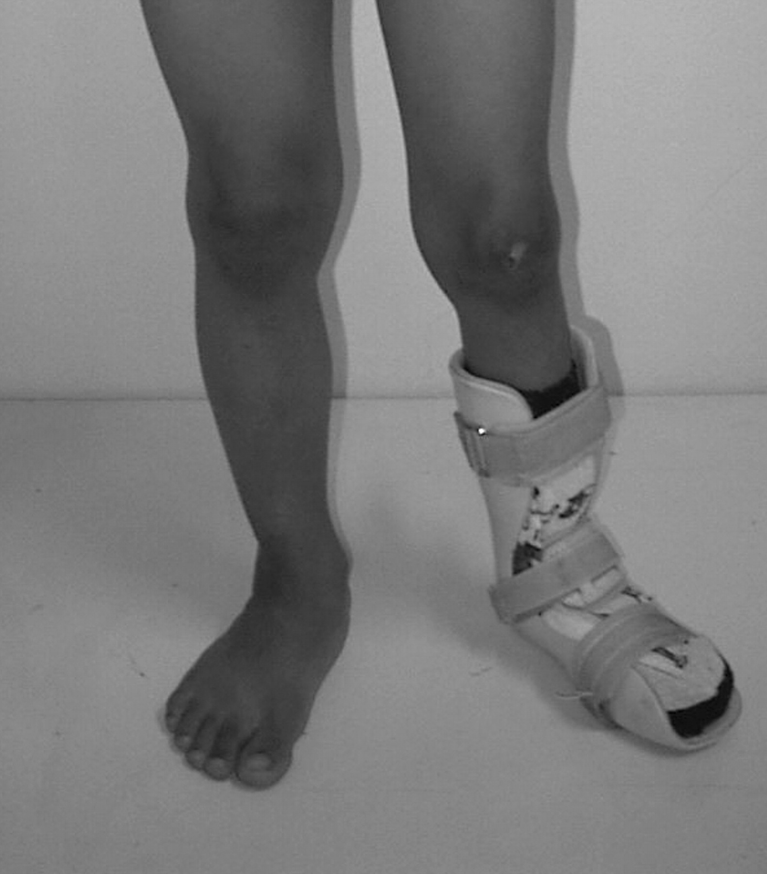 Fig. 2  
            Photograph showing the ankle foot orthosis used to maintain correction.
          