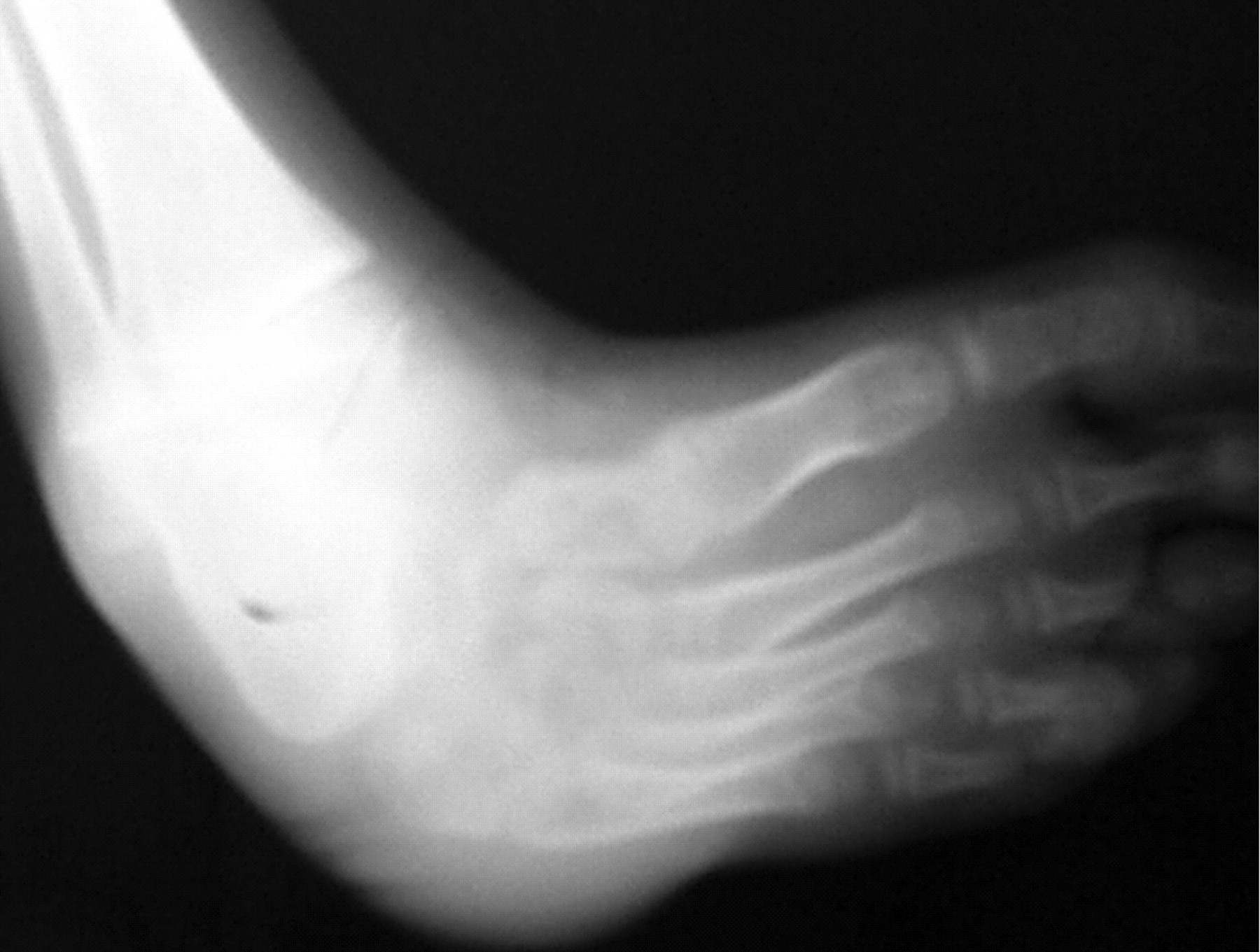 Fig. 3a, Fig. 3b, Fig. 3c  
            Radiographs a) before treatment showing the severe deformity of the foot, b) a lateral view with good alignment of the foot and mild flattening of the talus at three years, and c) an anterolateral view with correction of the forefoot at three years. There is minimal residual medial displacement of the navicular with satisfactory alignment on the head of the talus.
          