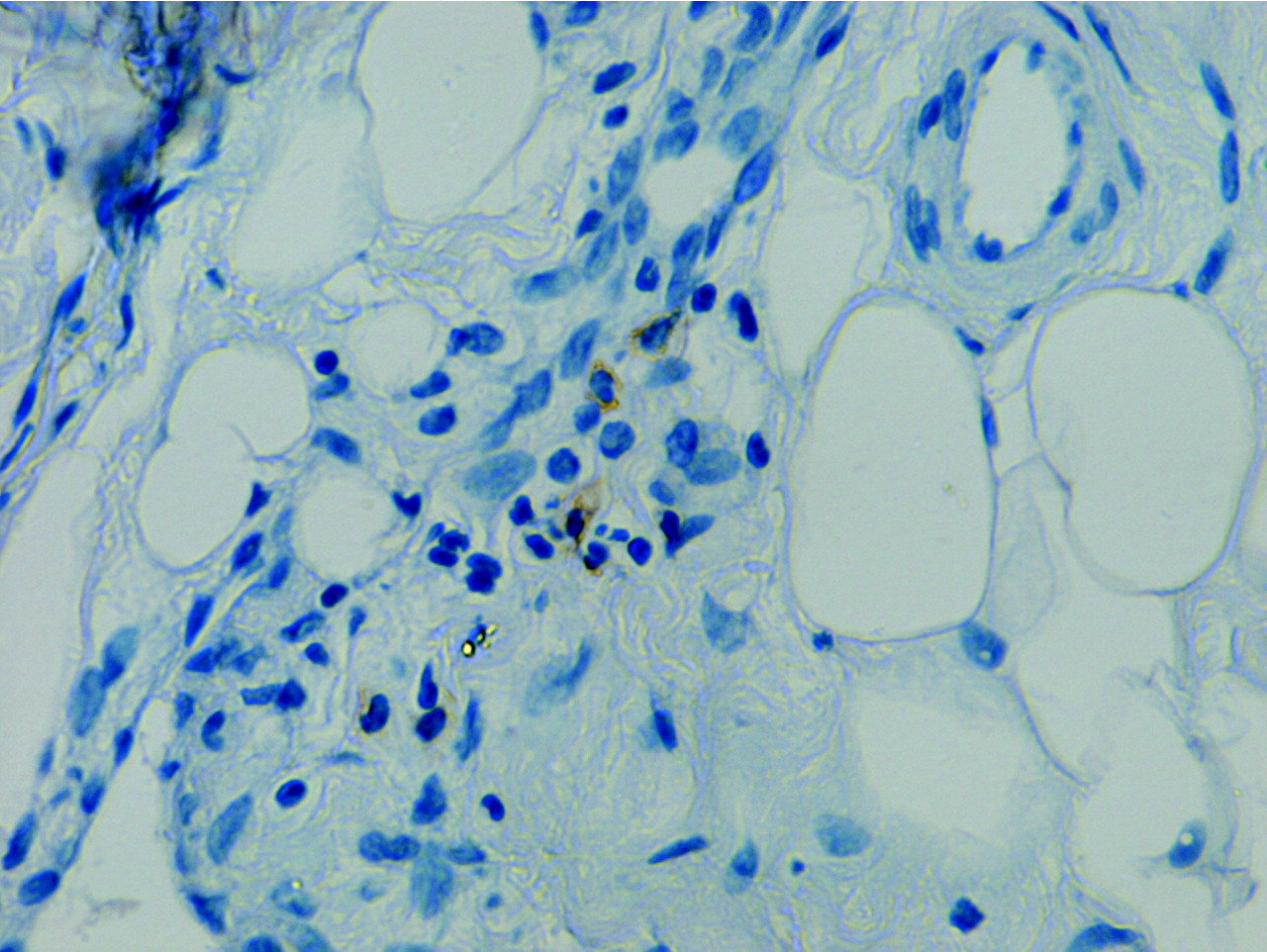 Fig. 3  
            CD20 B cells. Photomicrograph of immunocytochemistry, magnification ×400.
          