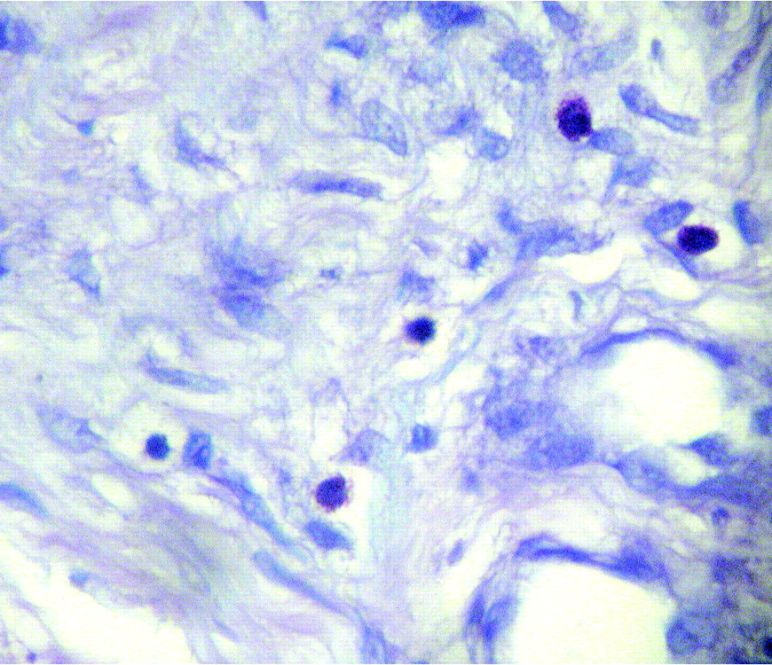 Fig. 5  
            Mast cells. Photomicrograph of toluidine blue staining, magnification ×400.
          