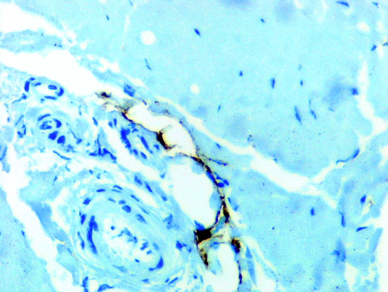 Fig. 6  
            Lyve 1 lymphatics. Photomicrograph of immunocytochemistry, magnification ×400.
          
