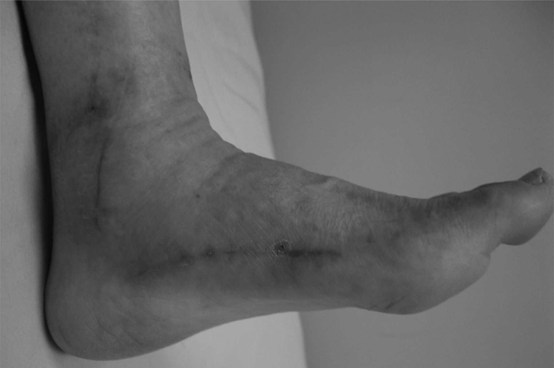 Fig. 1a, Fig. 1b, Fig. 1c, Fig. 1d  
            A 60-year-old woman with a checkrein deformity of the hallux, a) pre-operative radiograph showing a segmental fracture of the tibia and fibula, b) post-operative radiograph taken 22 months after the initial operation, c) the deformity recurred after release of adhesions and Z-plasty lengthening above the ankle at the fracture site. The checkrein deformity became more prominent when the ankle was passively dorsiflexed and d) correction after a second Z-plasty lengthening of the flexor hallucis longus tendon at the midfoot.
          