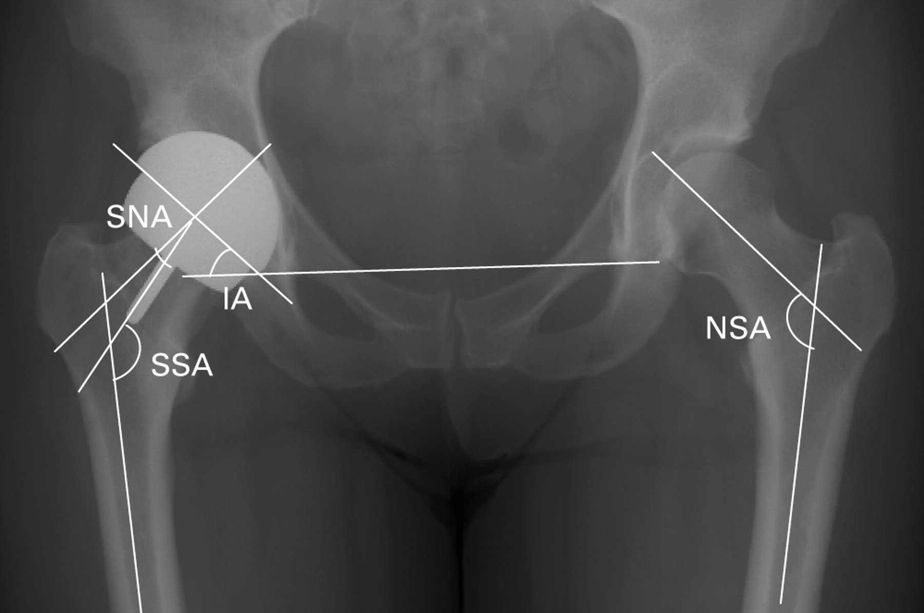 Fig. 1a, Fig. 1b  
            Radiograph showing a) measurement of the neck-shaft angle on the contralateral hip for illustrative purposes only, the stem-neck angle (SNA) and the inclination angle (IA) (SSA, stem-shaft angle, NSA, neck-shaft angle) and b) calculation of the anteversion angle using EBRA software.
          