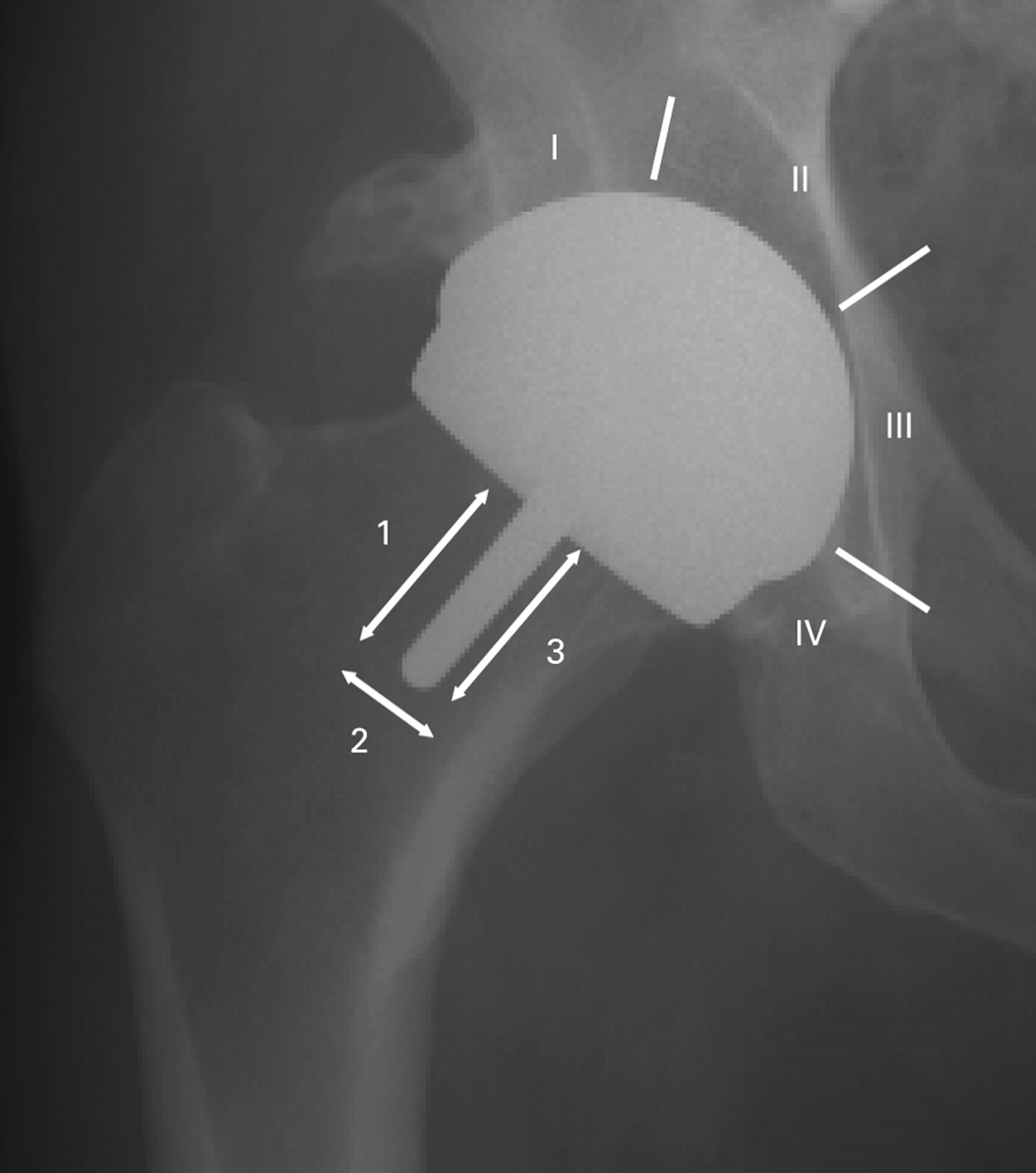 Fig. 2  
            Radiograph showing the radiolucent zones of DeLee and Charnley38 (acetabular side, modified by Beaulé et al.39 I to IV) and of Amstutz et al40 (femoral stem, 1 to 3).
          