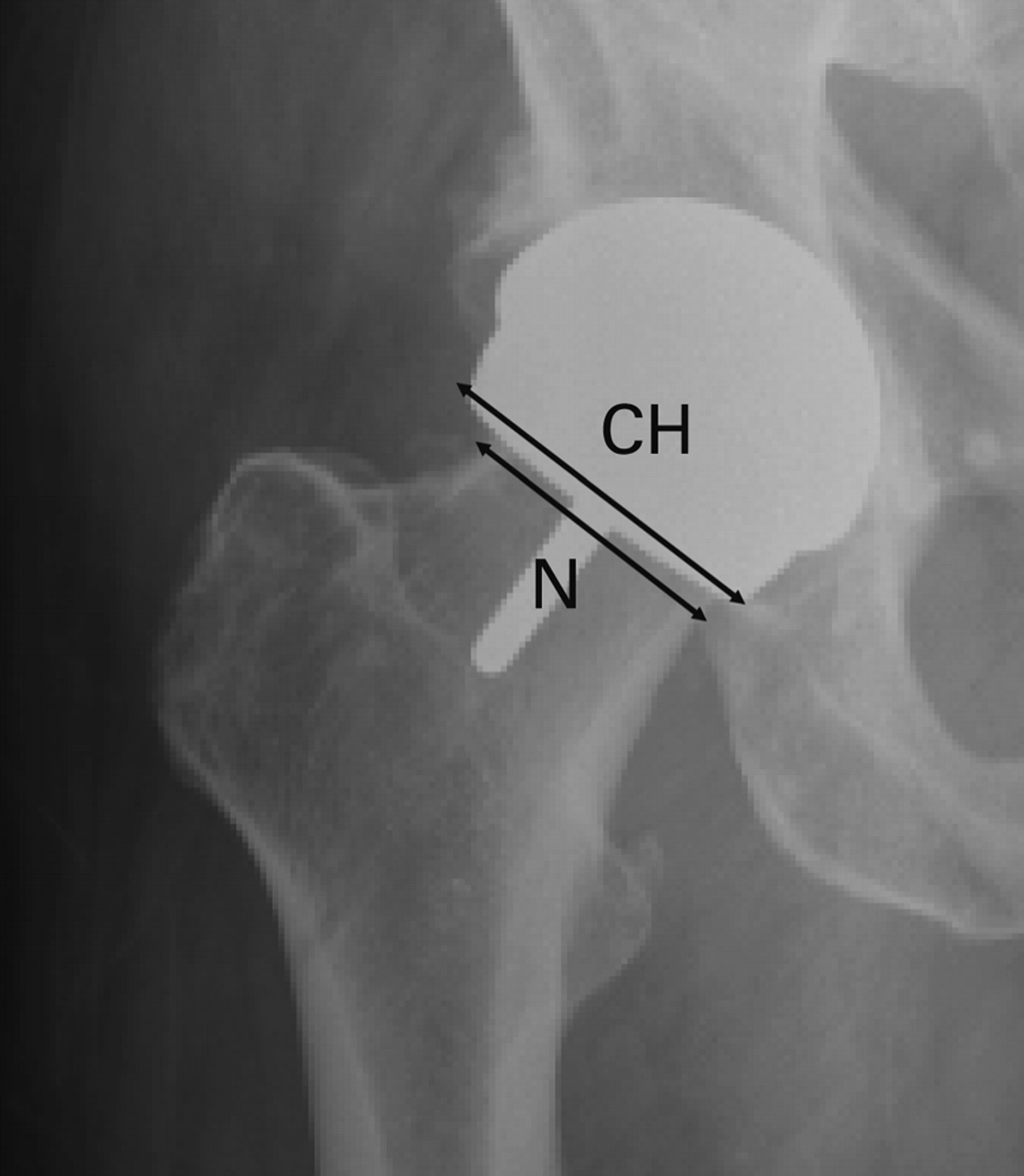 Fig. 3  
            Radiograph showing the measurements taken from a standardised AP radiograph of the pelvis to calculate the component head (CH): neck (N) ratio.
          