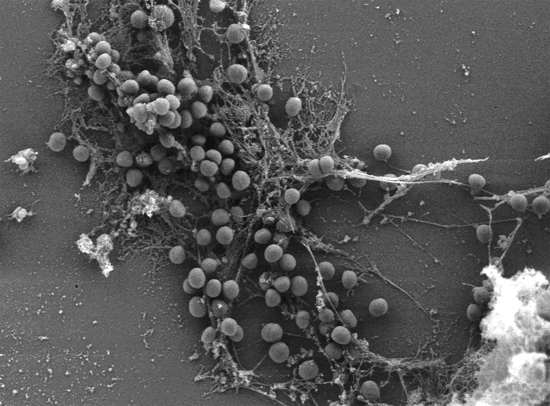 Fig. 1  
            Scanning electron microscope image showing a multilayered cluster of Staphylococcus epidermidis covered by biofilm (72 hours old) after exposure to 500 impulses at 0.16 mJ/mm2 in a Ringer’s lactate solution (×5000 magnification).
          