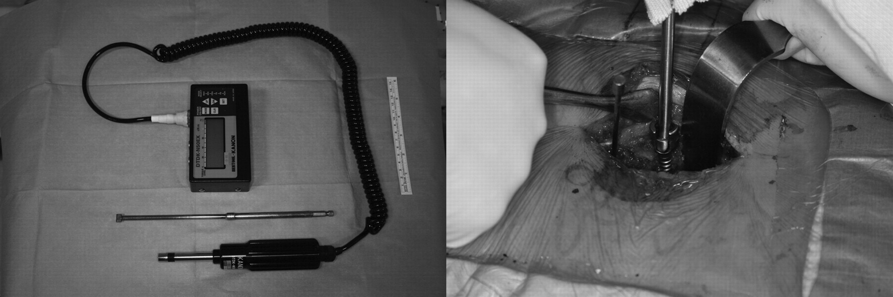 Fig. 1 
          Clinical photographs showing the
portable torque-measuring machine (left) and the torque gauge (DTDK-N50EX;
Kanon) connected to the pedicle screw with a specially designed
holder (right).
        