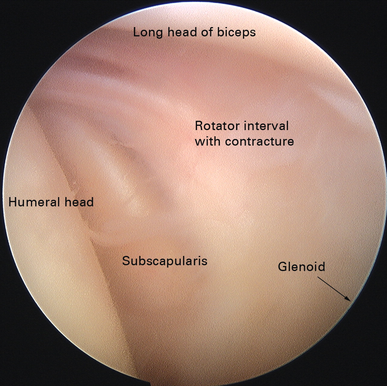 Fig. 2 
          The arthroscopic appearances of primary
frozen shoulder. The glenohumeral joint is viewed from a posterior
portal and the characteristic appearance of scarring in the rotator
interval is shown.
        