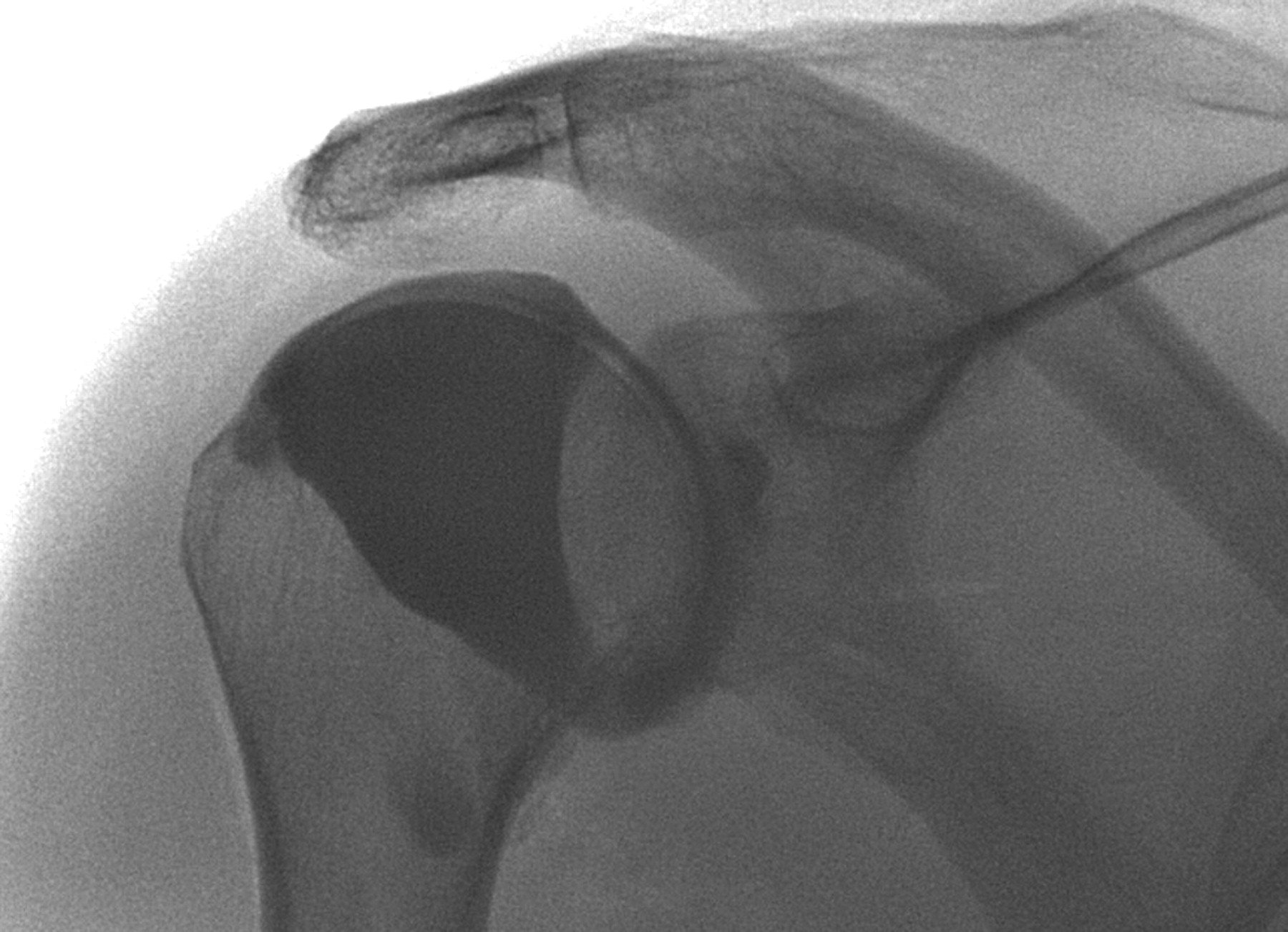 Fig. 3 
            The characteristic arthrographic appearances
of frozen shoulder. The joint volume is reduced and there is no
filling of the inferior capsular recess.
          