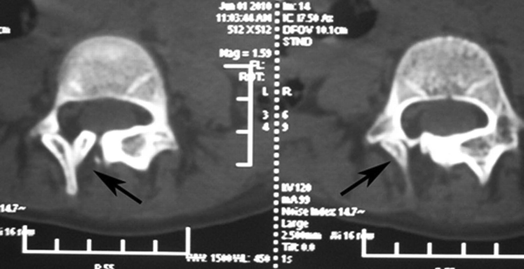 Fig. 2 
          CT scans of a six-year-old female with
a Type 2 diastematomyelia, showing a single dural sac and abnormal
development of the lamina and spinous process (arrows).
        