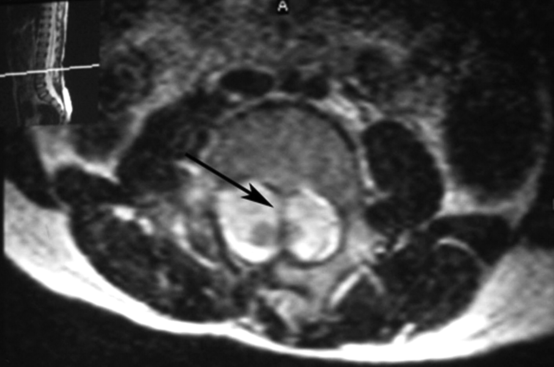 Fig. 3 
          Transverse view MRI scan from a six-year-old
male with a Type 1 diastematomyelia at L2-3 (arrow); the spinal
cord is split into two parts.
        