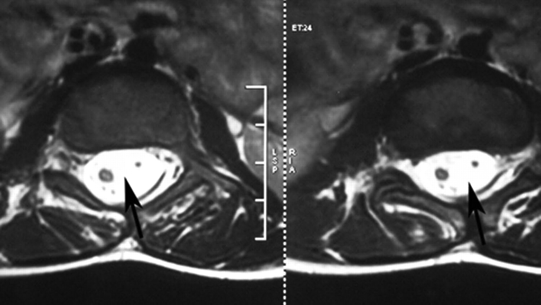 Fig. 5 
          MRI frontal sections of the patient
with a Type 2 diastematomyelia in Figure 2, showing a single dural
sac (arrows).
        