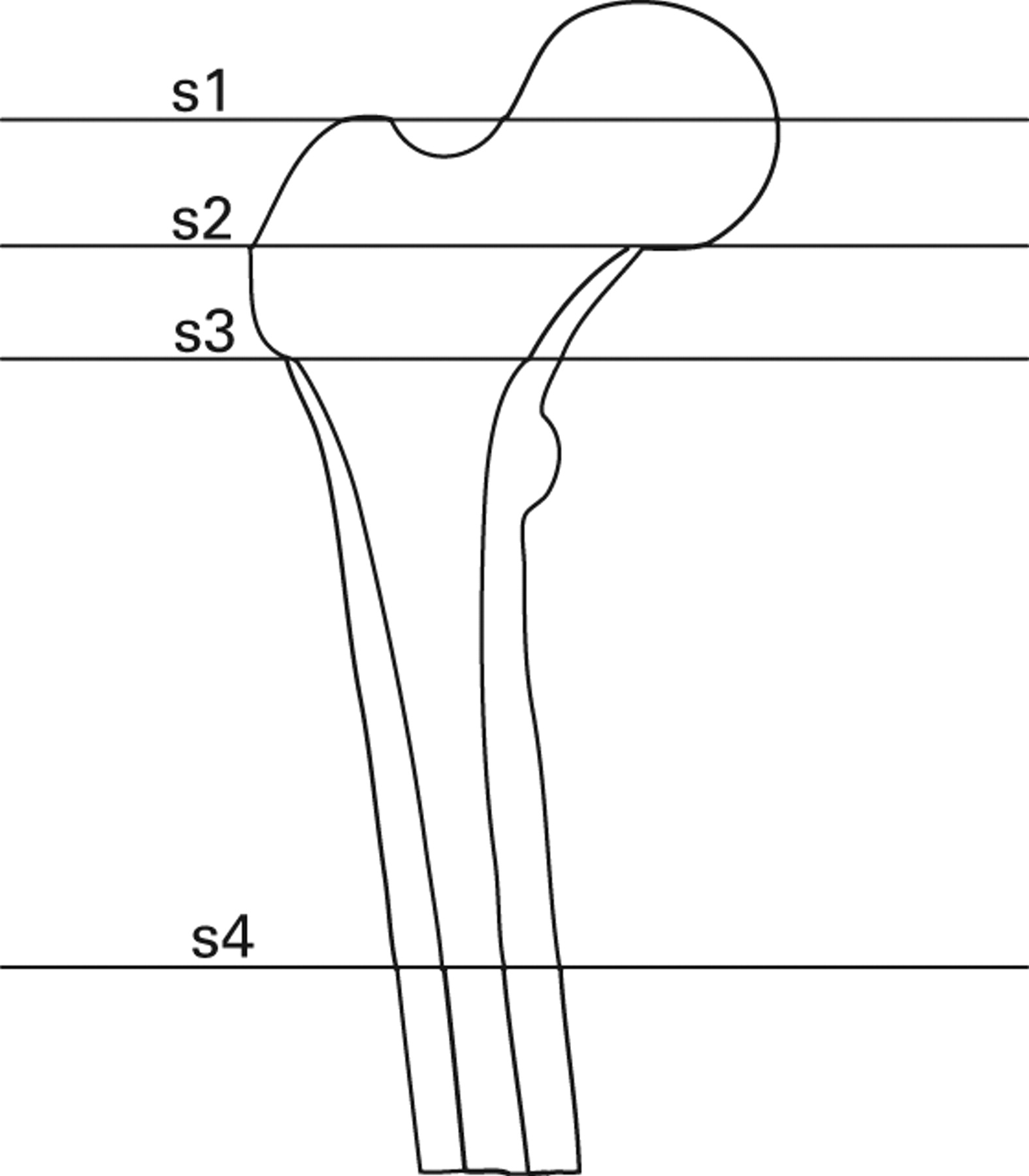 Fig. 2 
          Diagram showing selection of CT slices
of the proximal femur for three-dimensional calculation of femoral
offset and femoral anteversion (s1, centre of the femoral head;
s2, femoral neck axis; s3, centroid of the proximal femoral metaphysis;
s4, centre of femoral isthmus).
        