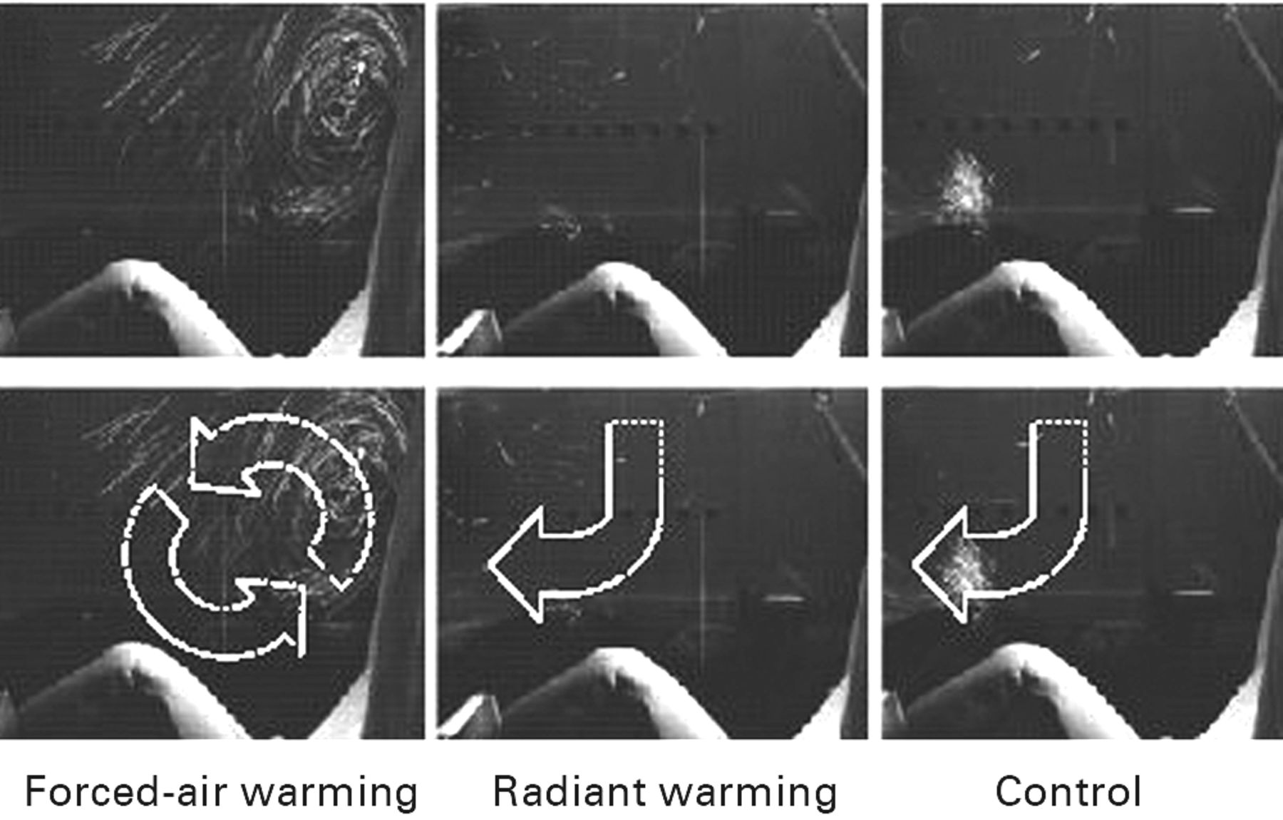 Figs. 2a - 2b 
            
              Figure 2a – diagram showing the
area in which the airflow was assessed. Figures 2b – example photographs
showing the visualisation of airflow using forced-air warming (left),
radiant warming (centre) and none (right). The lower images are illustrated
to emphasise the direction of airflow.
          