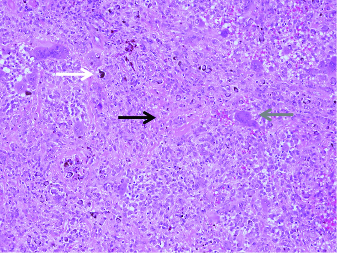 Figs. 1a - 1b 
          Photomicrographs of intra-articular
pigmented villonodular synovitis, a) at low power (original magnification
× 25), showing hyperplastic, haemosiderin-pigmented synovium and
joint space at the bottom right of the field, with the tumour vaguely
nodular, collagen rich and displaying incipient clefts, and b) at
high power (original magnification × 100), showing the tumour composed
of a disorderly mass of histiocytes (often containing haemosiderin)
(white arrow), osteoclast-like giant cells (grey arrow), and plump
fibroblasts depositing collagenous matrix (black arrow).
        