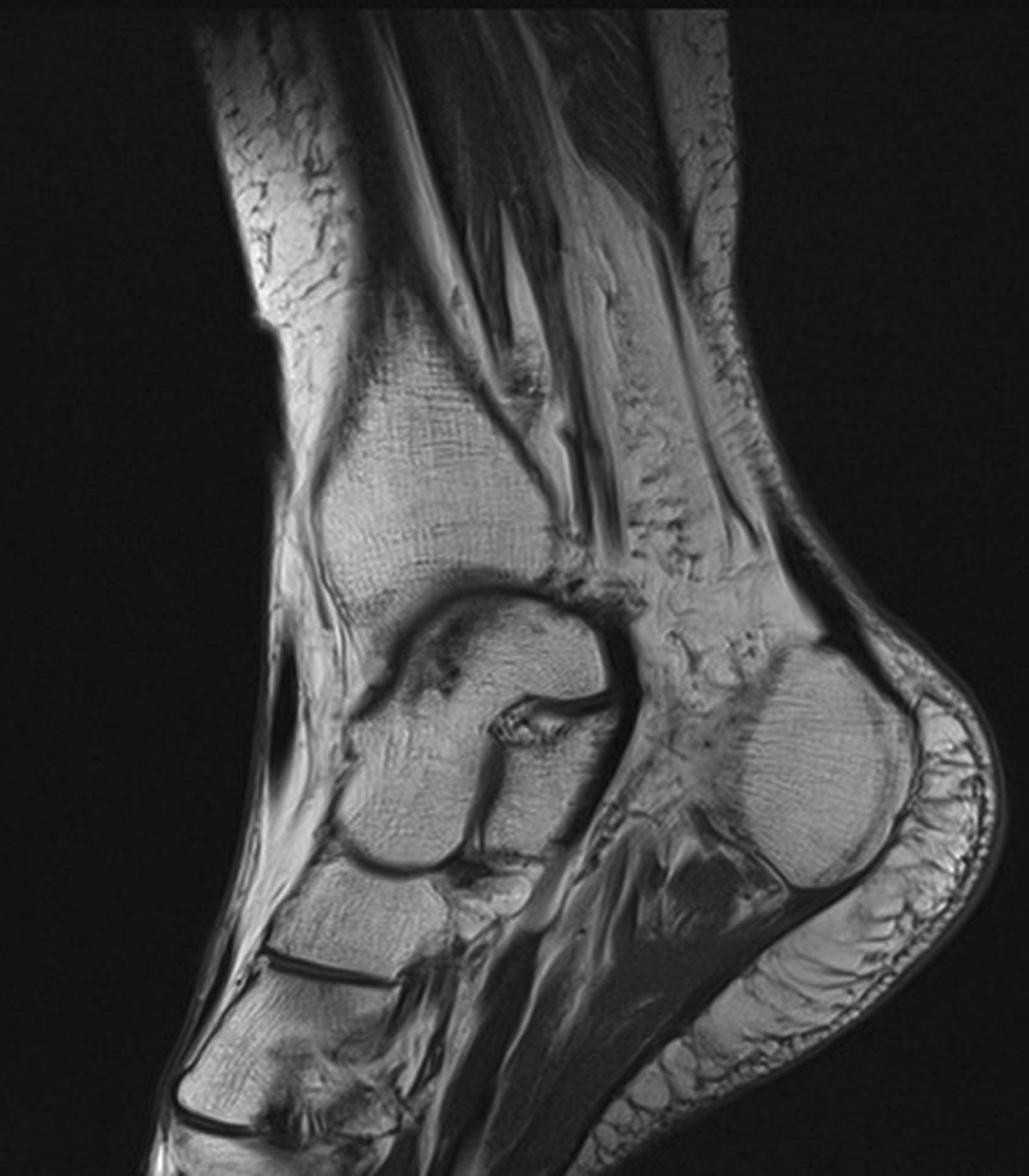 Figs. 2a - 2b 
          Sagittal MRI scans in a 46-year-old
female patient: a) T2-weighted scan at presentation after
excisional biopsy from the medial tibiotalar joint with residual
diffuse-type pigmented villonodular synovitis involving the flexor
tendon sheaths (arrows), and b) T1-weighted scan revealing
disappearance of the lesions six years later. She achieved excellent
clinical outcome scores eight years after excisional biopsy.
        