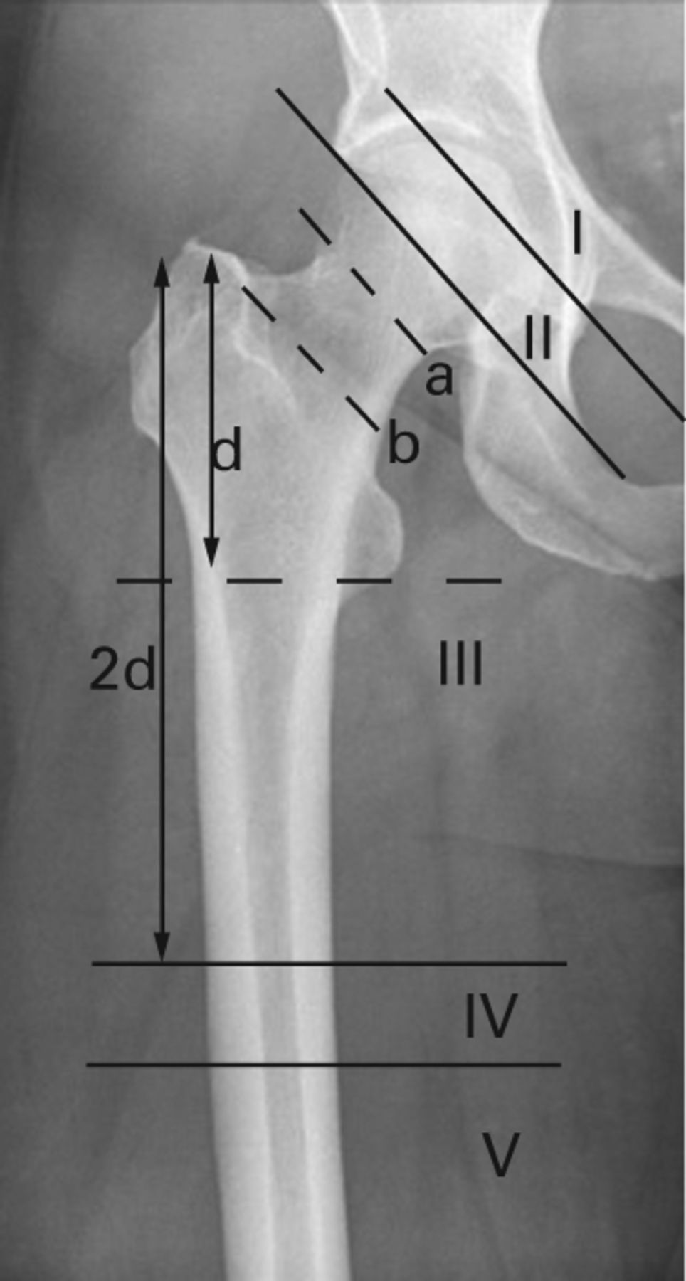 Fig. 1 
          Radiograph showing the classification
of stem length of the into types I–V (a: subcapital osteotomy level;
b: standard osteotomy level; d: distance between tip of greater
trochanter and base of lesser trochanter).
        