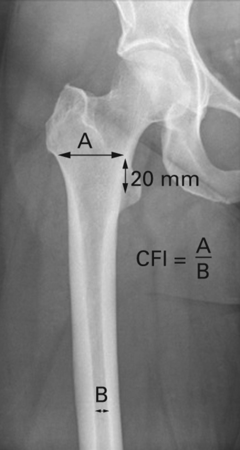 Fig. 2 
          Radiograph showing the canal flare index
(CFI): ratio of the canal diameter 20 mm above the level of the
lesser trochanter midpoint (A) and the canal diameter at the level
of the isthmus (B).
        