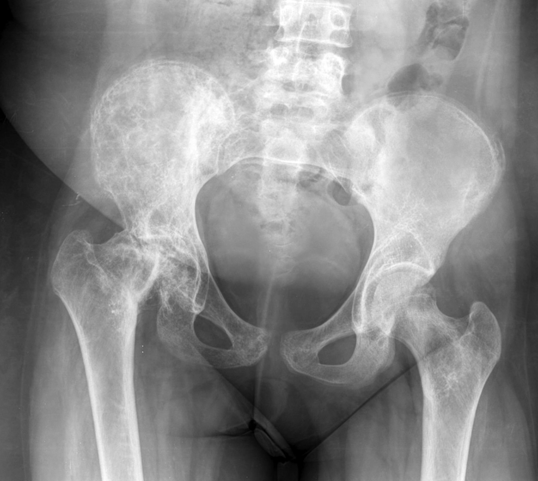 Figs. 1a - 1b 
          Anteroposterior radiographs of a
19-year-old patient showing a) a large area of radiation osteitis
in the right iliac wing and acetabulum, and avascular osteonecrosis
of the right femoral head 24 months after irradiation with 55 Gy
for a sarcoma of the gluteal region, and the same patient b) 42
months after a cemented total hip arthroplasty with a reinforcement
cross.
        