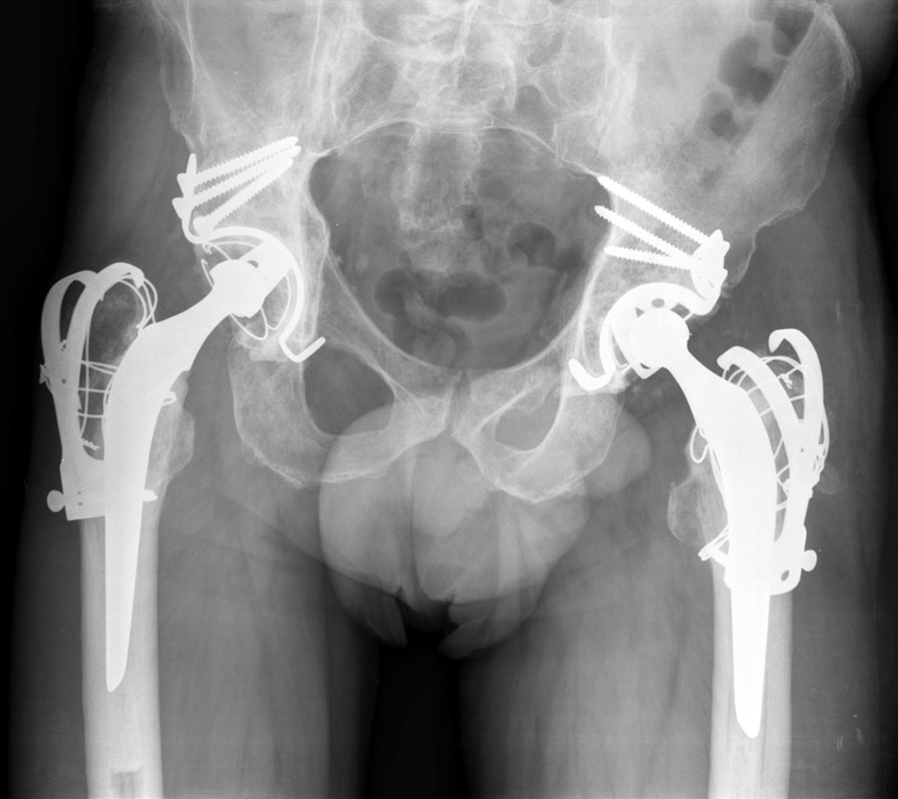 Figs. 2a - 2b 
          Anteroposterior radiographs of a
52-year-old patient a) 57 months after pelvic irradiation for cancer
of the ureter showing osteonecrosis of the acetabulum with a protrusion
of the right femoral head and the same patient b) 51 months after right
cemented total hip arthroplasty (THA) with a reinforcement cross
and 44 months after left THA for osteonecrosis of the femoral head.
        