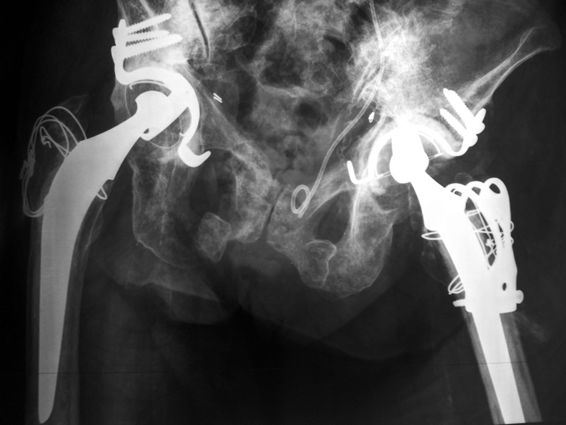Fig. 6 
          Anteroposterior radiograph of a 56-year-old patient
showing mechanical loosening of the left acetabular component 34 months
after a primary cemented total hip arthroplasty with an acetabular reinforcement
cross and significant radiation osteitis of the pelvis
        