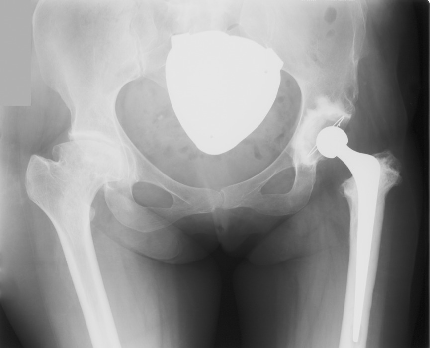 Figs. 3a - 3c 
          Progressive osteolysis of the
proximal femur. Radiographs at a) one year showing satisfactory
appearances; b) 15 years showing osteolytic changes. These appearances
and the diagnosis of Gauchers disease prompted closer monitoring
of this patient; and c) prior to revision at 21 years.
        