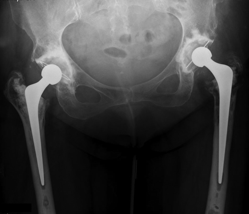 Figs. 3a - 3c 
          Progressive osteolysis of the
proximal femur. Radiographs at a) one year showing satisfactory
appearances; b) 15 years showing osteolytic changes. These appearances
and the diagnosis of Gauchers disease prompted closer monitoring
of this patient; and c) prior to revision at 21 years.
        