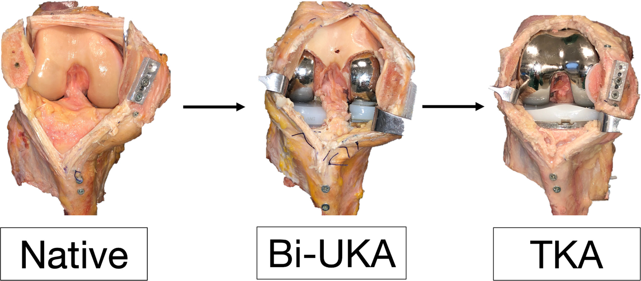 Fig. 4 
            Operative states for cadaveric testing. In the native and bi-unicondylar arthroplasty (Bi-UKA) states, the anterior cruciate ligament is intact and the patellofemoral joint is preserved; a transpatellar approach with longitudinal tendon split of rectus femoris, vastus intermedius, and the patellar tendon has been used to prevent disruption to the medial and lateral parapatellar tendons. TKA, total knee arthroplasty.
          
