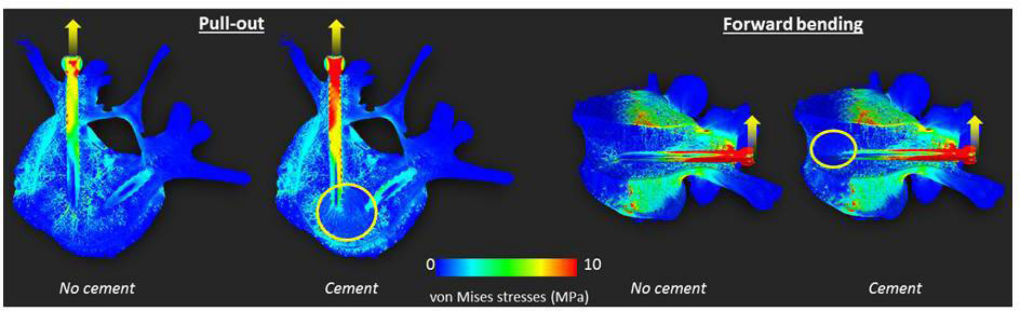 Fig. 4 
            Stress distributions in pull-out and bending within a typical full vertebra microfinite element model with and without cement augmentation (here shown for cement bridging both screw tips).
          