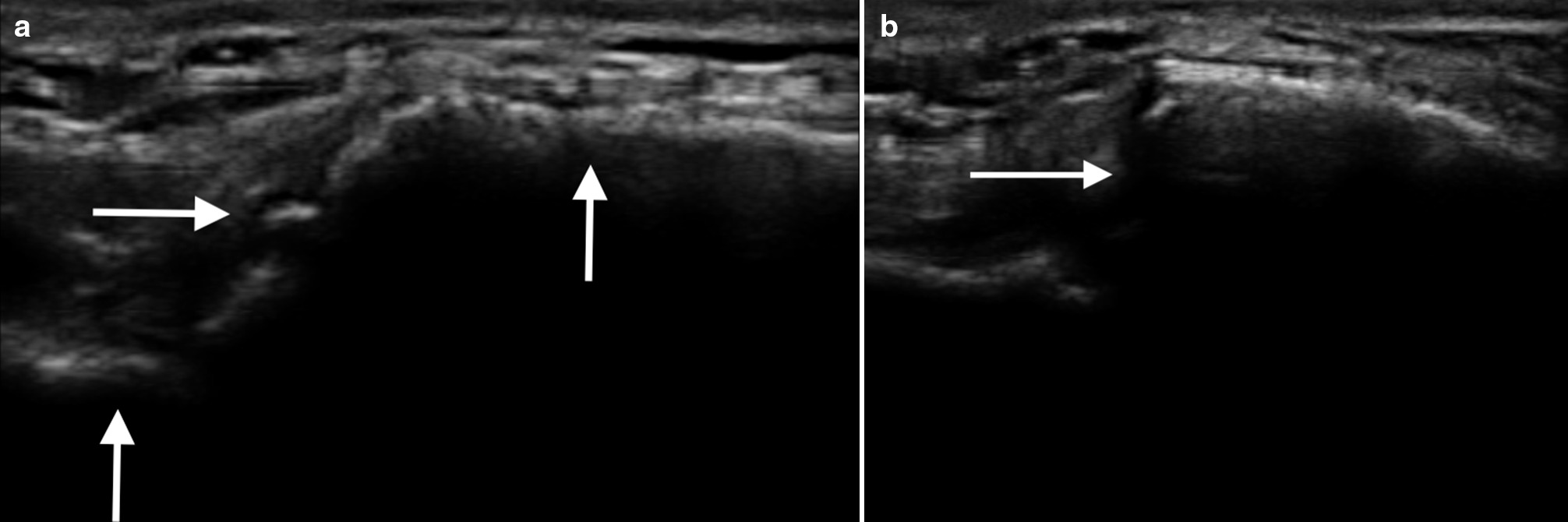 Fig. 2 
            a) Ultrasound example of six week bridging callus. Cortical surface of bone (vertical arrows), bridging callus (horizontal arrow). Note acoustic shadow below surface of bone. b) Example of anisotropy or loss of ultrasound signal during the same scan sequence. Orientation of the probe that is not perpendicular to the callus results in loss of signal of callus, as shown by the horizontal arrow.
          