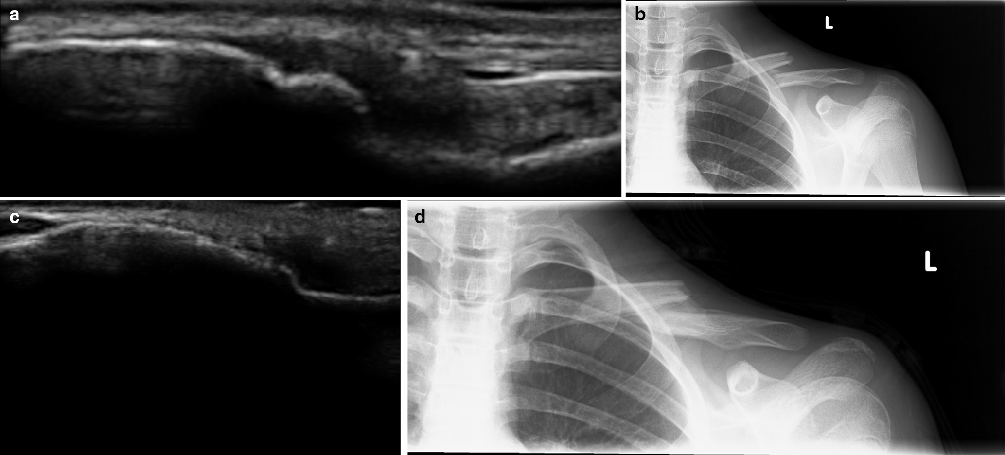 Fig. 6 
            Remodelling of bridging callus on ultrasound as seen in an 18-year-old male. a) Six-week sonographic bridging callus at fracture site; b) six-week anteroposterior radiograph showing minimal callus formation; c) 12-week ultrasound scan showing remodelling of sonographic bridging callus; d) 12-week anteroposterior radiograph with bridging callus now evident.
          