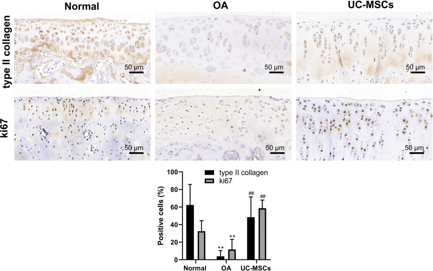 Fig. 5 
            Human umbilical cord mesenchymal stem cells (UC-MSCs) promoted matrix synthesis and chondrocyte proliferation in monosodium iodoacetate (MIA)-induced osteoarthritis (OA) cartilage. The articular cartilage was immunostained for the expression of collagen II and ki67. The percentage of positive cells (in brown colour) for both collagen II and ki67 was calculated, respectively. Data shown are mean and standard deviation from three rats/group. **p < 0.01 versus normal group, ##p < 0.01 versus UC-MSC-treated groups.
          