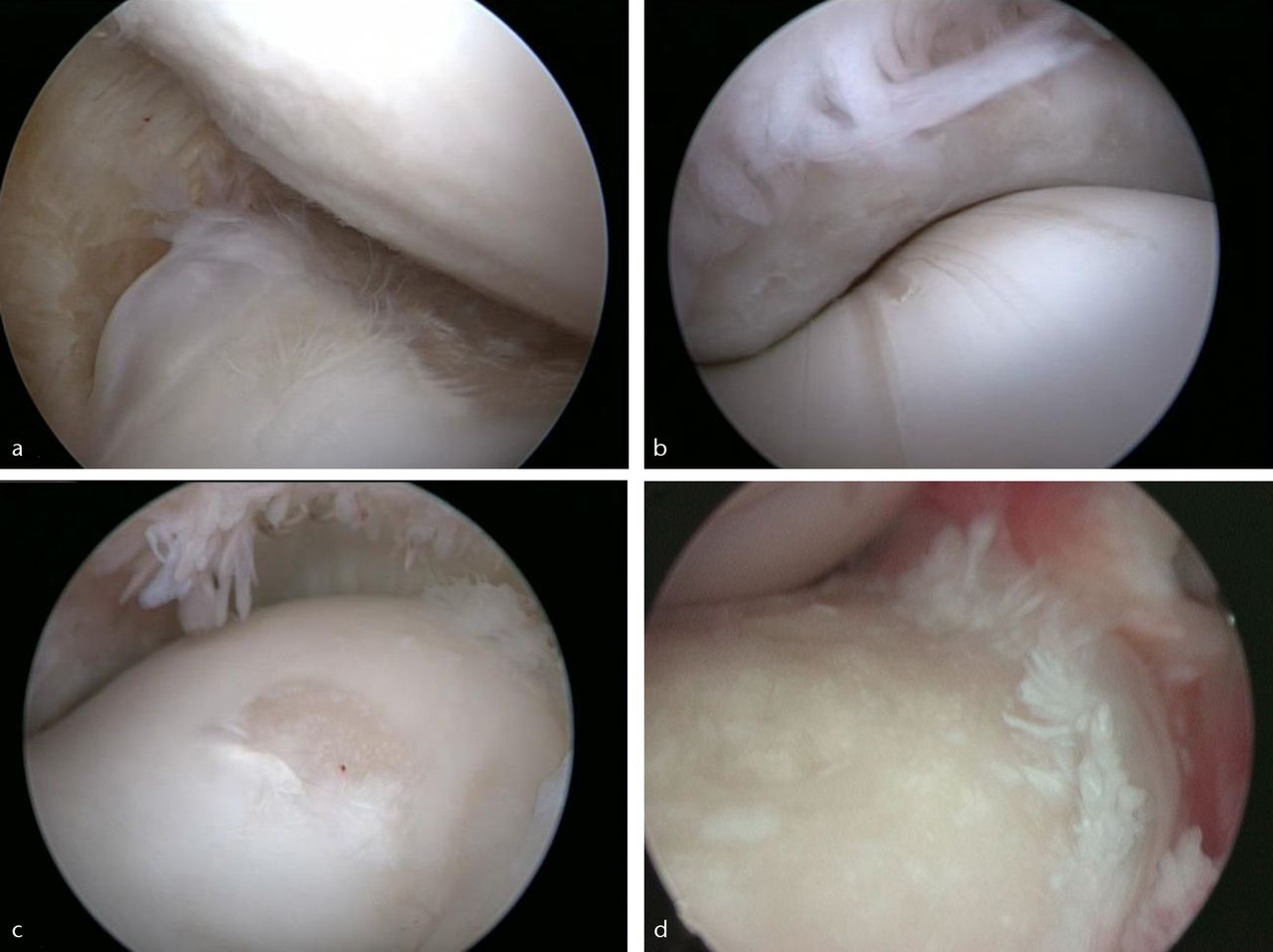 Fig. 4 
          Arthroscopic images of a) the medial
aspect of middle carpal joint, showing erosion of articular cartilage
and osteophytosis on radial carpal bone, and minor cartilaginous
disease on the opposing surface of the third carpal bone, b) the
metacarpophalangeal joint, showing wear line formations signifying early
osteoarthritis on the distal metacarpus, c) the metacarpophalangeal
joint, showing focal cartilage erosion on the medial condyle of the
distal metacarpus, and d) the middle carpal joint, showing severe
erosion of articular cartilage on the distal radial carpal bone.
        