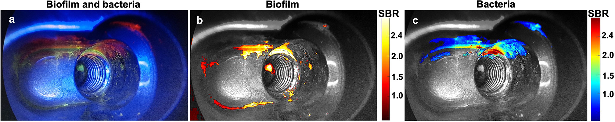 Fig. 4 
            Multicolour imaging of components of bacterial growth on the screw hole of a femur prosthesis. Representative imaging of: a) the biofilm unprocessed; b) at the SYBR Green filter setting and pseudo-coloured processing with SYBR Green; and c) UBI29-41-Cy5. Heat bars: SBR, signal-to-background ratio of fluorescence intensity. n = 3.
          