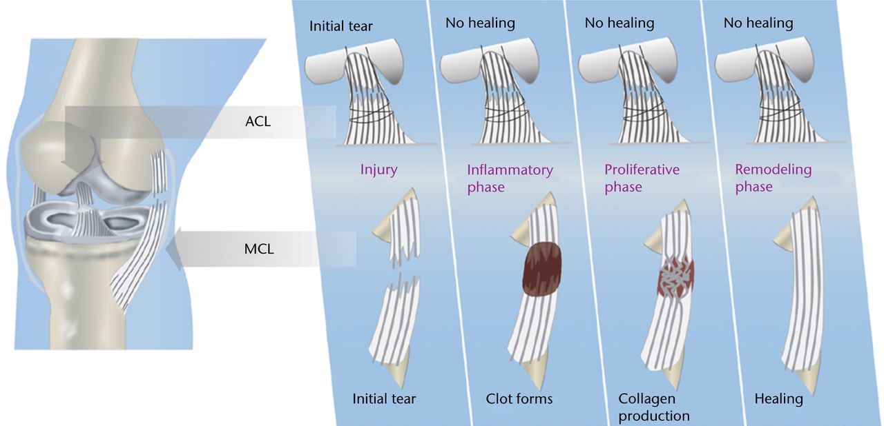 Fig. 2 
          Diagrams showing the differences in
intrinsic healing response of the anterior cruciate ligament (ACL;
top) and medial collateral ligament (MCL; bottom), highlighting
the lack of provisional scaffold (blood clot) formation within the
ACL wound site as the key mechanism for ACL healing failure (reproduced
with permission from Murray and Fleming63).
        