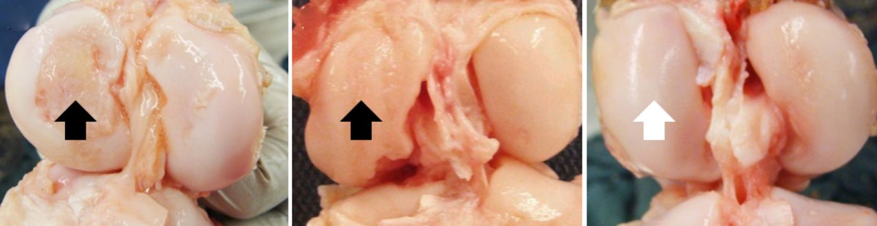 Fig. 6 
          Photographs showing the distal femoral
cartilage at one year after a) an untreated anterior cruciate ligament
(ACL) rupture, b) after conventional ACL reconstruction, and c)
bio-enhanced ACL repair. Note the damage to the medial femoral condyle
in the untreated and ACL-reconstructed knee (black arrows). No damage
to the medial femoral condyle in the bio-enhanced ACL-repair knee
(white arrow) was observed (adapted and modified with permission
from Murray and Fleming 182).
        