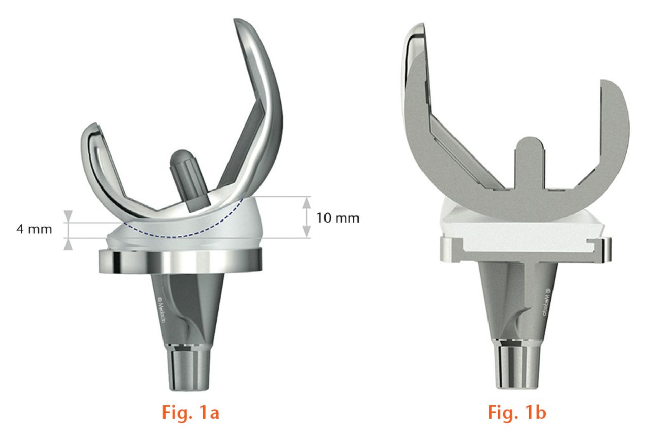  
            The GMK Sphere prosthesis incorporates a spherical medial tibiofemoral articulation (left) to provide anteroposterior stability and a flat lateral tibial surface to permit longitudinal rotation (right).
          