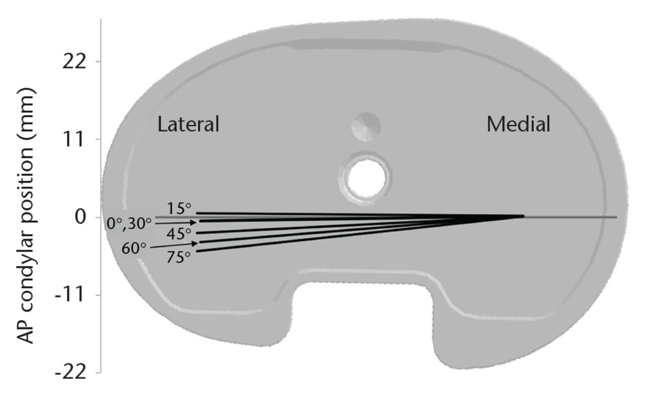 Fig. 3 
            The femoral condyles rotate about a fixed medial centre during the step-up/down activity. Generally, knees rotated from 1° to 6° tibial internal rotation as the femur flexed from 0° to 75° flexion. The figure shows the mean position and rotation of the femoral condyles with respect to a medium-size tibial baseplate during the step-up/down activity. (AP, anteroposterior)
          