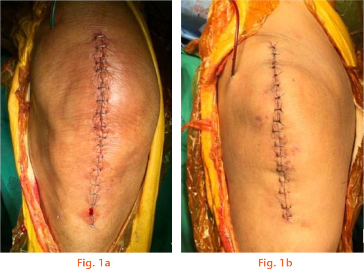  
          Photographs showing how half of the wound was closed with staples and other half with nylon sutures; a) staple/suture group, b) suture/staple group.
        